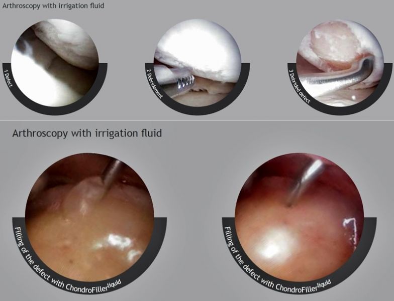 ChondroFiller3 ChondroFiller