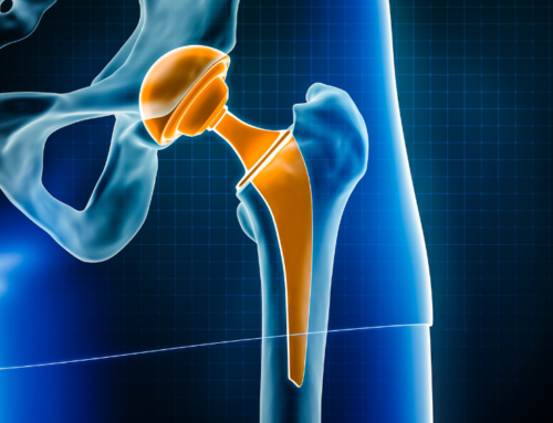 Co warto wiedzieć o endoprotezoplastyce stawu biodrowego?